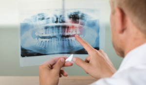 Bone Augmentation, Lethbridge Periodontist